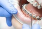 Can Braces Improve Teeth That Sit Too Far Back?