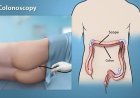 Painless Colonoscopy Hospital in Guwahati: Procedure Detailspainless colonoscopy hospital in guwahati