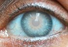 Kala Motia Specialist in Delhi: Diagnosis and Treatment