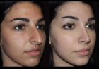 Why Consult the Best Septoplasty Surgeon in Dubai Before Surgery?