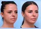Thread Lift Treatment in Dubai Creating Firmer Smoother Facial Appearance