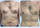 Assessing Lower Chest Fullness with Best Gynecomastia Surgeons in dubai