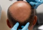 Can FUE Hair Transplant Help Restore a Thinning Crown?