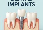 Dental Implant in Kathmandu: Restore Your Smile at Glow Skin & Dental Clinic