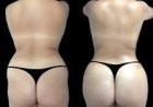 Butt Fat transfer surgery in dubai: What to Know About Weight Changes After Surgery