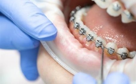 Can Braces Improve Teeth That Sit Too Far Back?