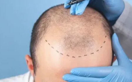Can DHI Help Improve Your Hair Density?