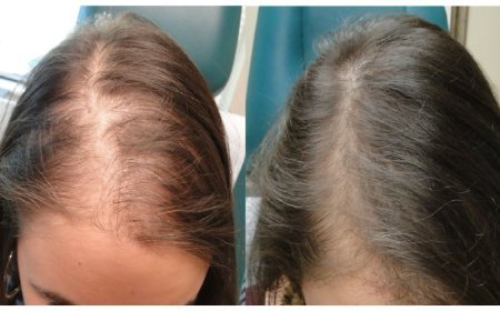 Why Is Your Hair Thinning Around the Temples?