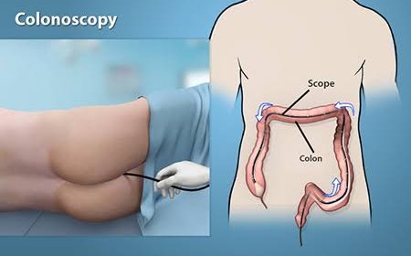 Painless Colonoscopy Hospital in Guwahati: Procedure Detailspainless colonoscopy hospital in guwahati