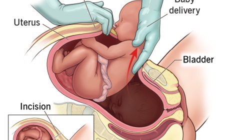 Cesarean Section: Preparation, Procedure, and Healing