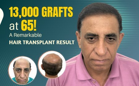 65-Year-Old, 13,000 Grafts Implanted In A Single Session: An Insight Into A Remarkable Hair Transplant Procedure