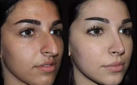 Why Consult the Best Septoplasty Surgeon in Dubai Before Surgery?