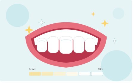 Teeth Whitening: A Guide to a Brighter Smile