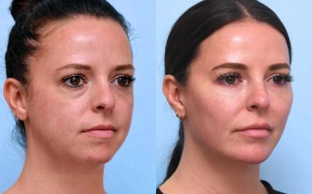 Thread Lift Treatment in Dubai Creating Firmer Smoother Facial Appearance