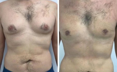 Assessing Lower Chest Fullness with Best Gynecomastia Surgeons in dubai