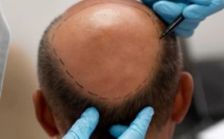 Can FUE Hair Transplant Help Restore a Thinning Crown?
