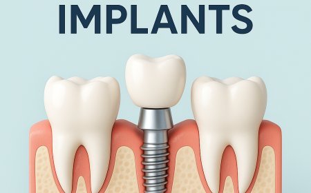 Dental Implant in Kathmandu: Restore Your Smile at Glow Skin & Dental Clinic