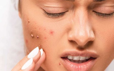 Acne Treatment in Dubai: Causes, Options and Skin Care Guide
