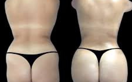 Butt Fat transfer surgery in dubai: What to Know About Weight Changes After Surgery