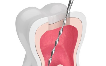 Root Canal Treatment In Mohali