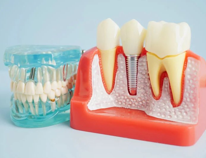 What If the Infection Comes Back After a Root Canal?