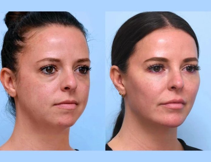 Thread Lift Treatment in Dubai Creating Firmer Smoother Facial Appearance
