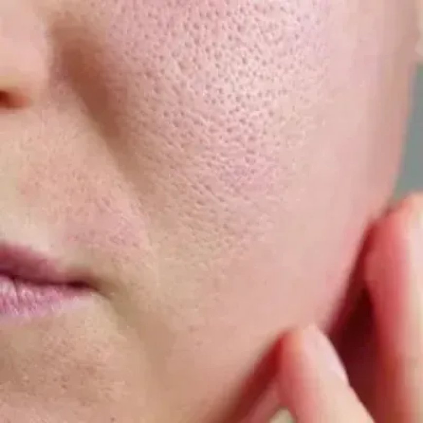 Large Pores Treatment in Riyadh for Smooth and Flawless Skin