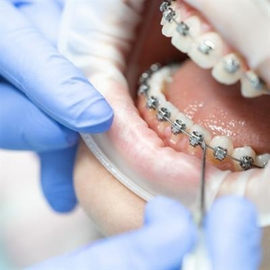 Can Braces Improve Teeth That Sit Too Far Back?
