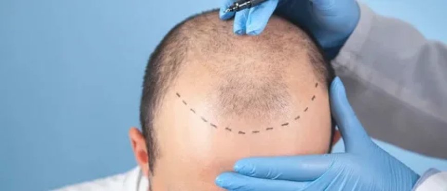 Can DHI Help Improve Your Hair Density?