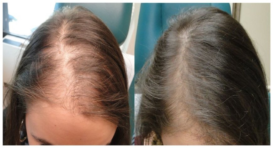 Why Is Your Hair Thinning Around the Temples?