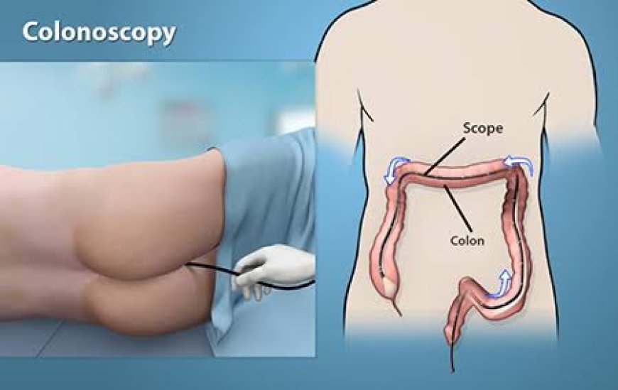 Painless Colonoscopy Hospital in Guwahati: Procedure Detailspainless colonoscopy hospital in guwahati