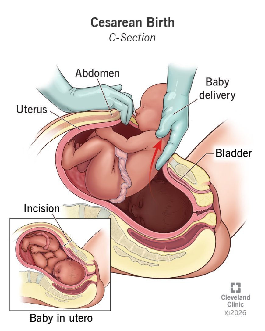 Cesarean Section: Preparation, Procedure, and Healing
