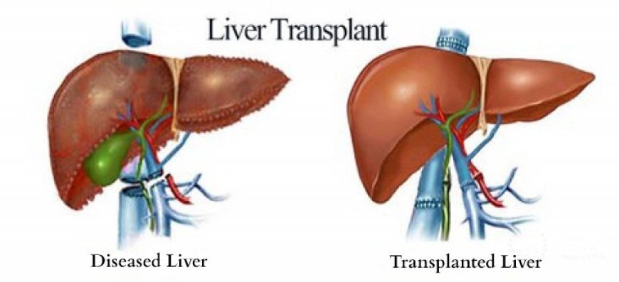 Best Liver Transplant Doctor in Noida: Care and Expertise