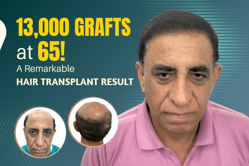 65-Year-Old, 13,000 Grafts Implanted In A Single Session: An Insight Into A Remarkable Hair Transplant Procedure