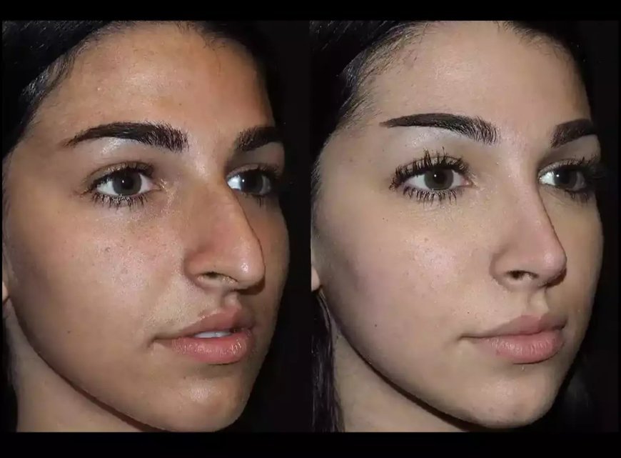 Why Consult the Best Septoplasty Surgeon in Dubai Before Surgery?