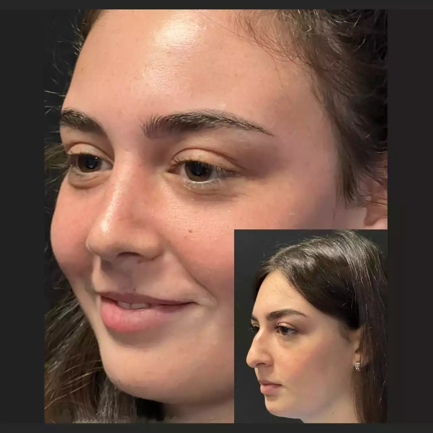 How Does the Best Rhinoplasty Surgeon in Dubai Ensure Safety?