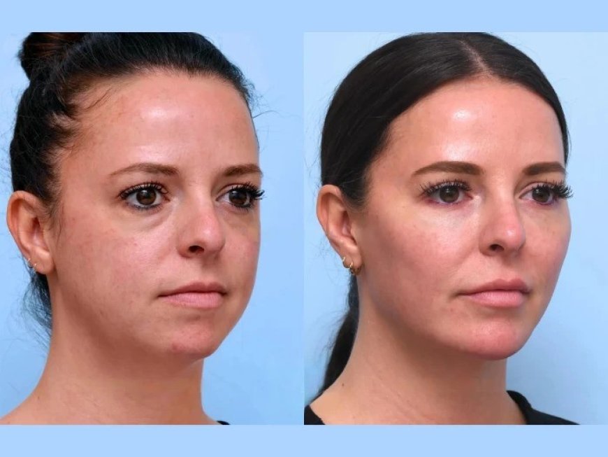Thread Lift Treatment in Dubai Creating Firmer Smoother Facial Appearance