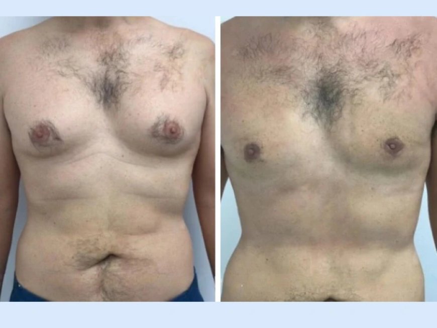 Assessing Lower Chest Fullness with Best Gynecomastia Surgeons in dubai