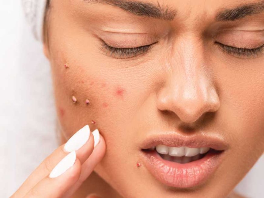 Acne Treatment in Dubai: Causes, Options and Skin Care Guide