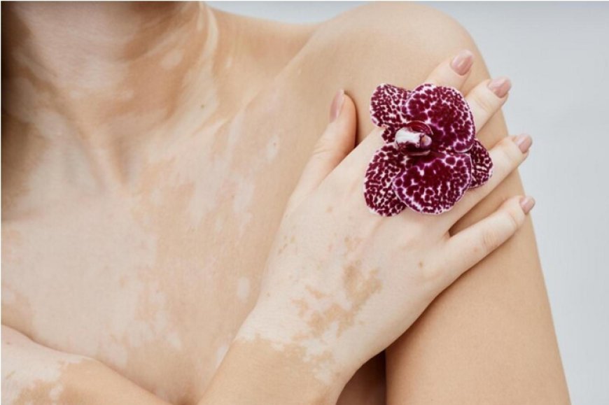 Value of Regular Follow-up: Homoeopathy and Vitiligo
