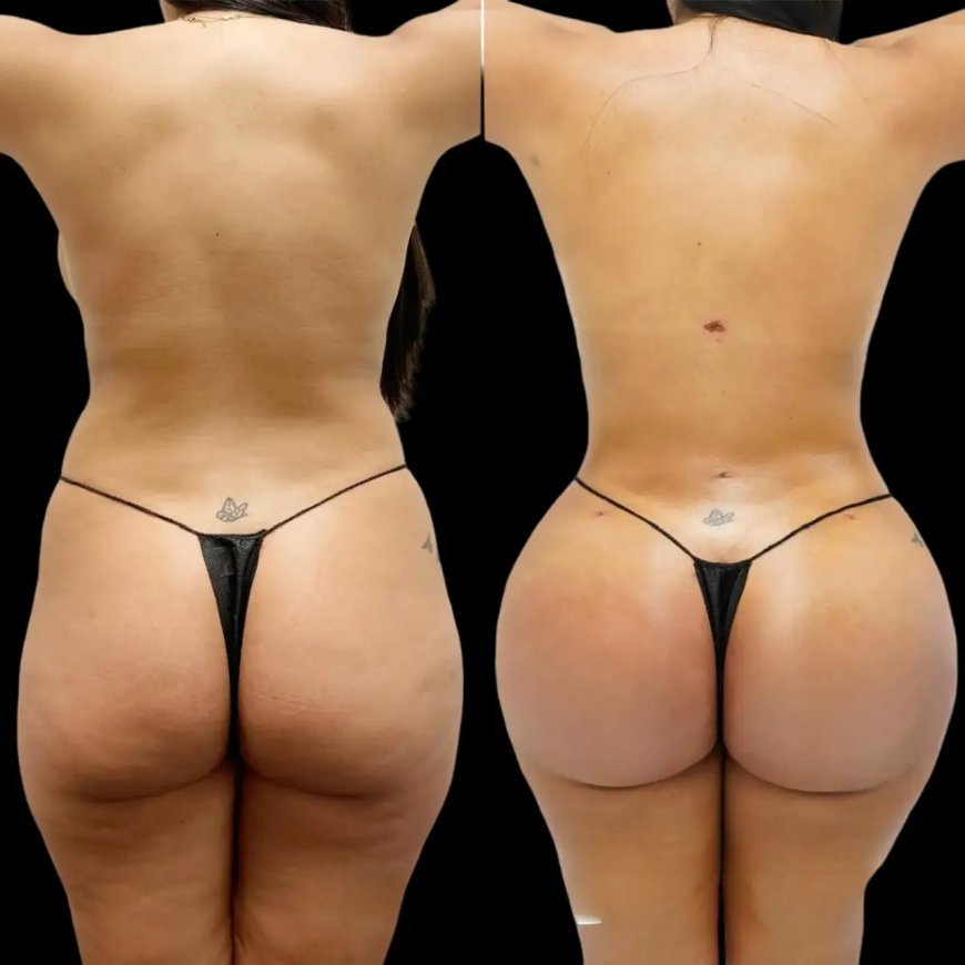 Fat Transfer Surgery in Dubai: The Role of Nutrition in Recovery