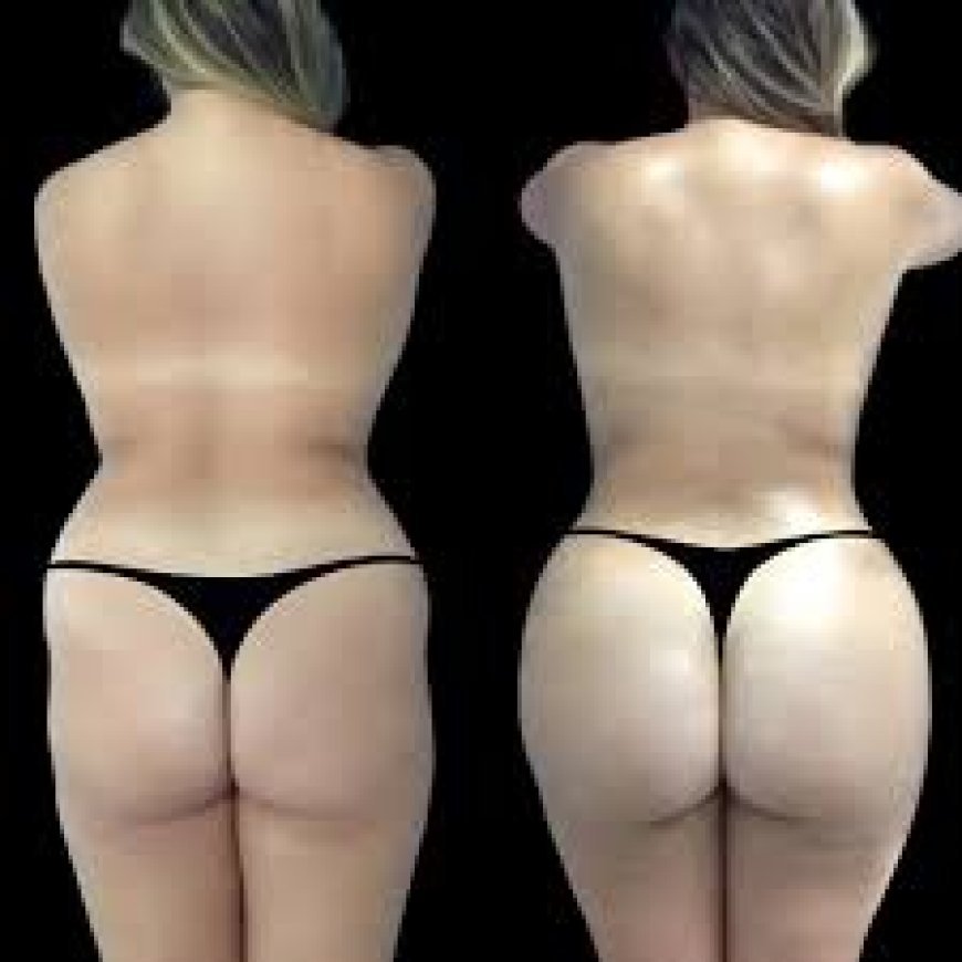 Butt Fat transfer surgery in dubai: What to Know About Weight Changes After Surgery