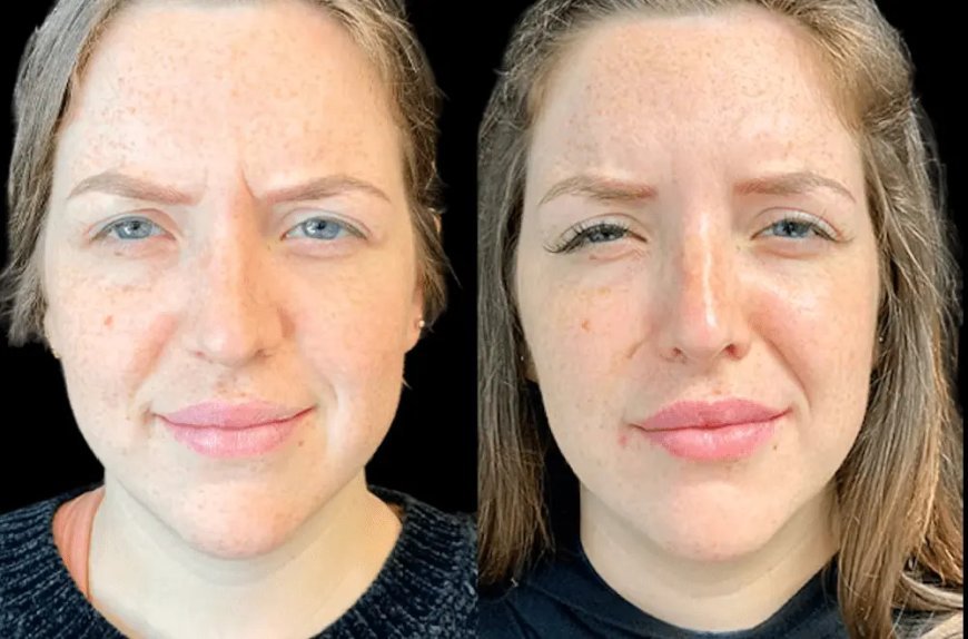 Best Aesthetic Clinics in dubai for Botox Safety and Aftercare Tips