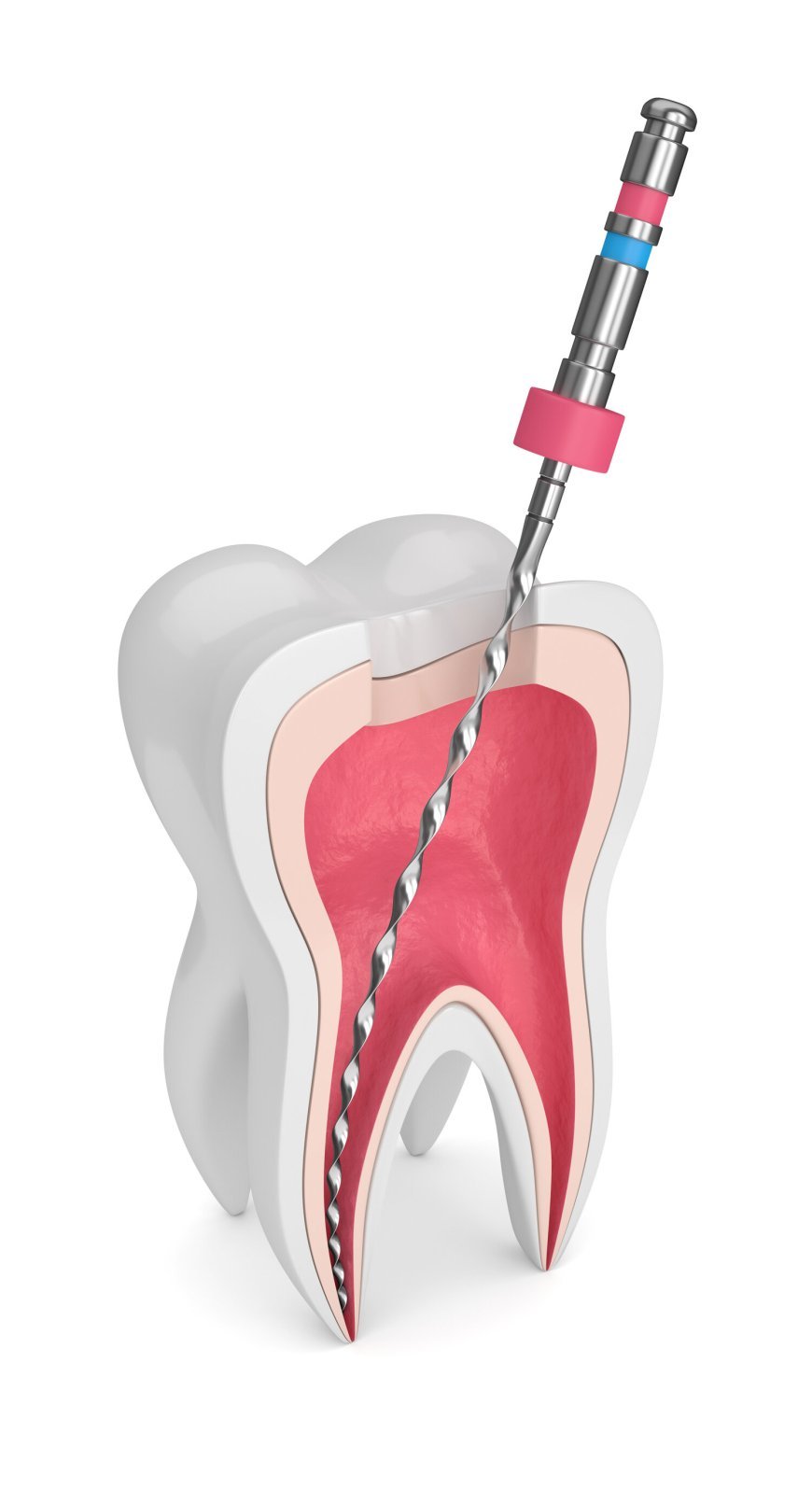 Root Canal Treatment In Mohali